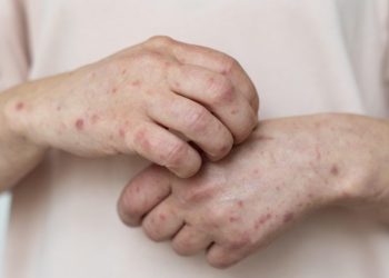 Se registra primera muerte por sarampión en Chihuahua