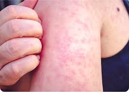 Se registra primera muerte por sarampión en Sonora