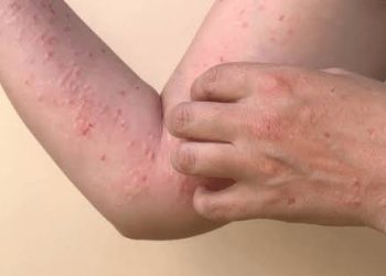 Confirman primera muerte por Mpox